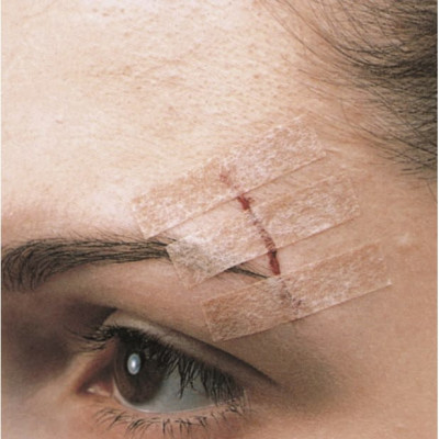 Set 3 vỉ 30 miếng dán thay chỉ khâu da 3M Steri-strip™ R1546 – Size 6mm x 100mm | Sản xuất tại Mỹ