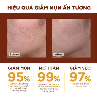 Kem Nghệ Giảm Mụn Oriss Giúp Mờ Thâm Sẹo Dưỡng Ẩm Sáng Da 20g
