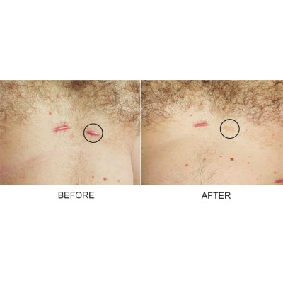 Strataderm 5g - Gel Silicone ngăn ngừa sẹo lồi, sẹo xấu, sẹo lâu năm