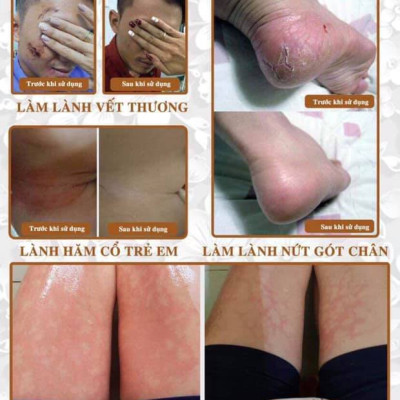 Mỡ Trăn N