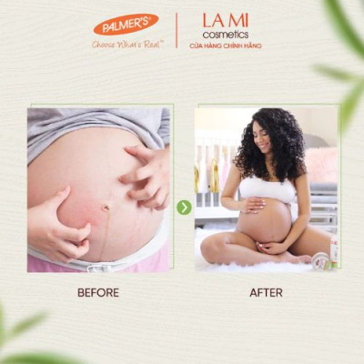 Dầu giảm nhanh khô ngứa da khi mang thai Palmer