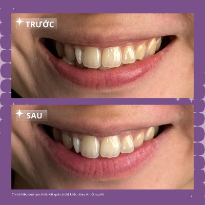 [Quà tặng không bán] Serum điều chỉnh màu răng Zenyum Bright 30ml